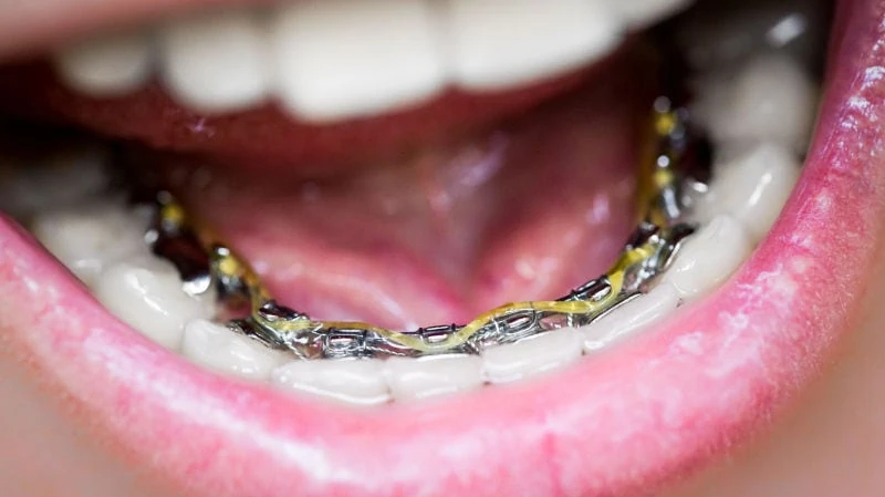 Ασθενής με γλωσσικά σιδεράκια που δεν φαίνονται στο εσωτερικό μέρος των δοντιών.