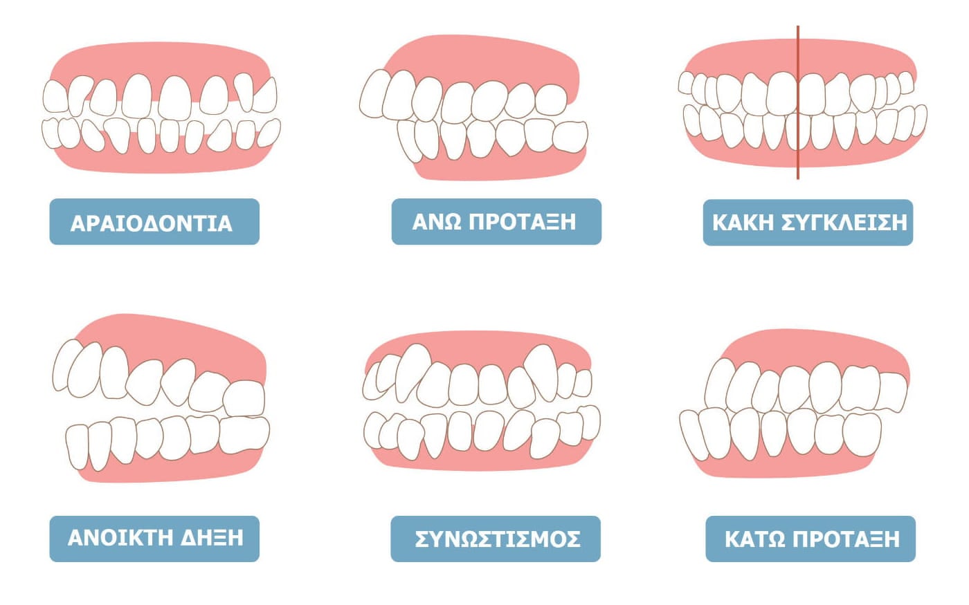 Invisalign θεραπείες στην Advanced Dental Clinics Αθήνα