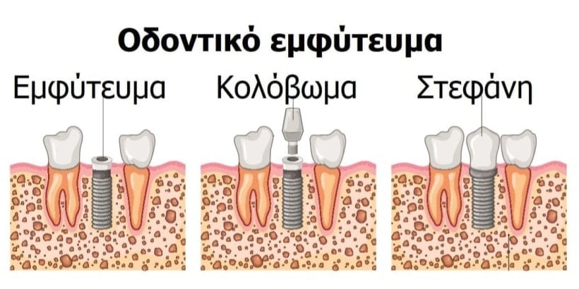Τι είναι το οδοντικό εμφύτευμα